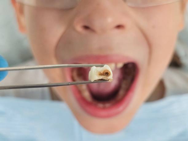 Best Urgent Tooth Repair  in Gunnison, UT